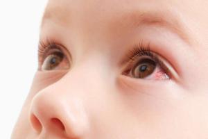 Nguy cơ nhiễm trùng, mù lòa do tự chữa đau mắt đỏ tại nhà