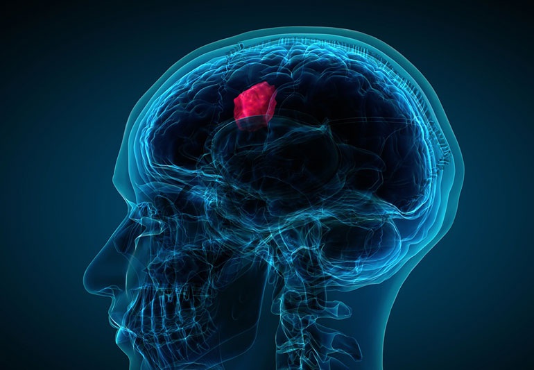 4 dấu hiệu cảnh báo khối u di căn não cần lưu ý
