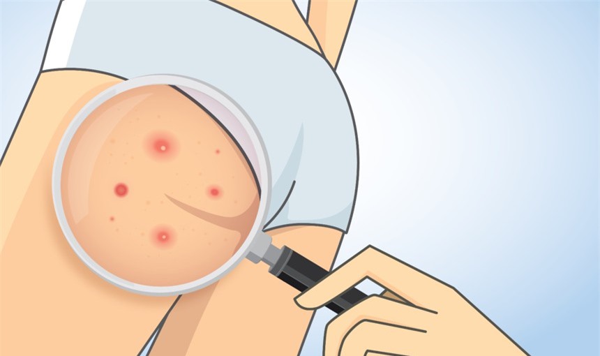 Với bí quyết đơn giản dưới đây bạn sẽ không cần phải lo bị mụn ở vòng 3