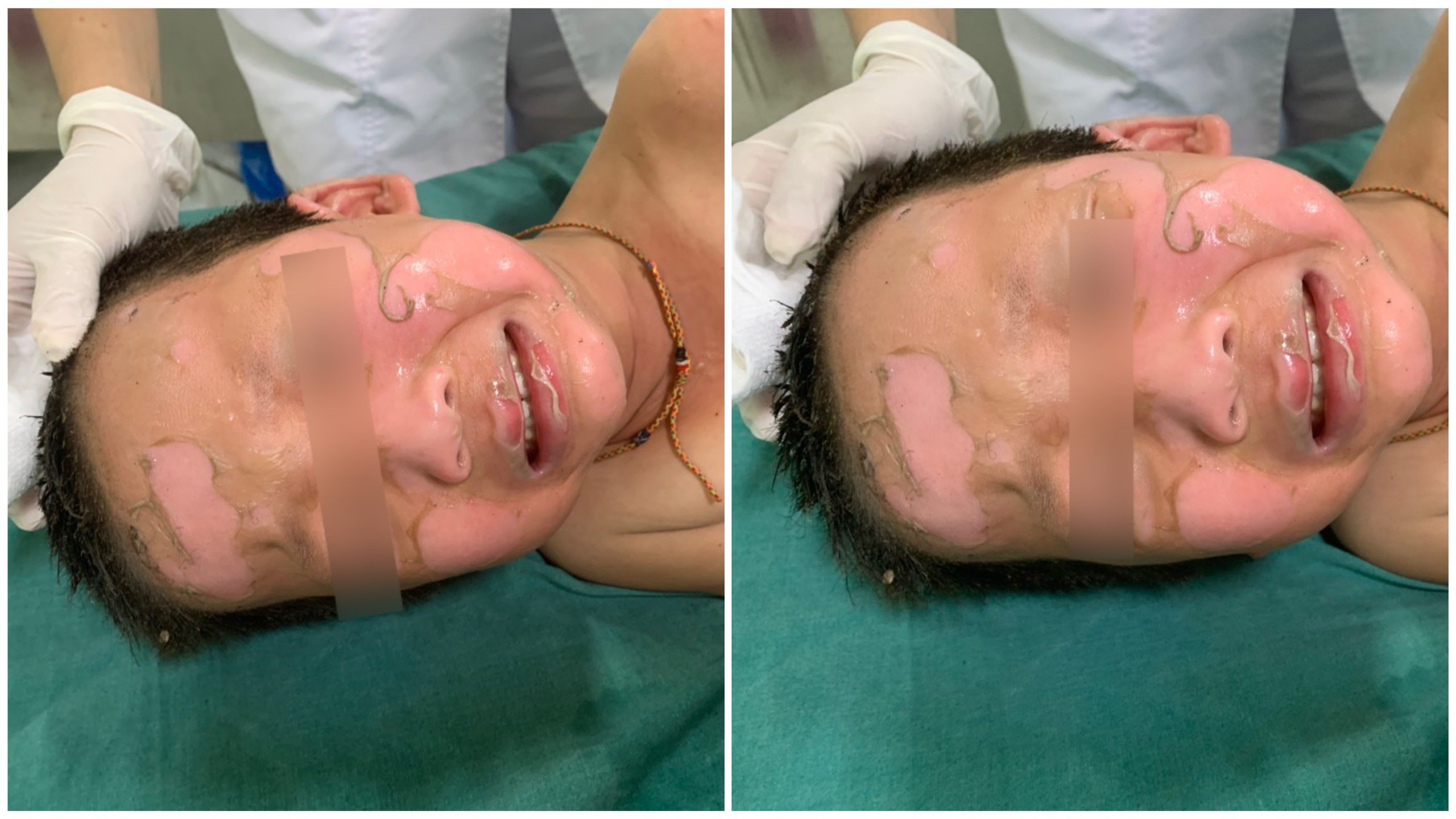 Quảng Nam: Bé trai 4 tuổi bỏng toàn mặt do bóng bay nổ